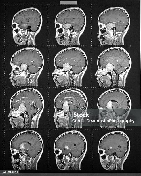 Por Ressonância Magnética Do Cérebro Mostrando Tumor - Fotografias de stock e mais imagens de Cuidados de Saúde e Medicina