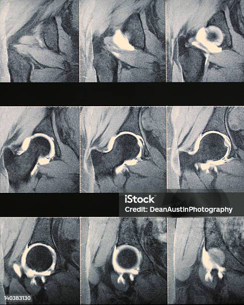 Arthogram Scan Mri Arthrogram Of The Hip Stock Photo - Download Image Now - Hip - Body ...