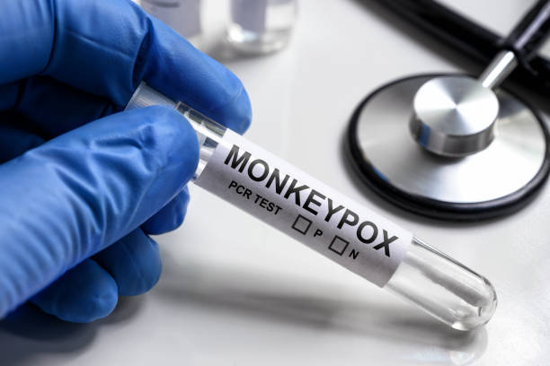 Monkeypox PCR test tube in doctors hand, medical kit for monkey pox virus diagnostics stock photo