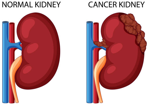 normalna nerka i rak nerki - kidney cancer stock illustrations