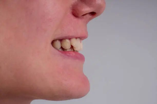 Photo of white smile with curvature tooth of young woman on background in studio