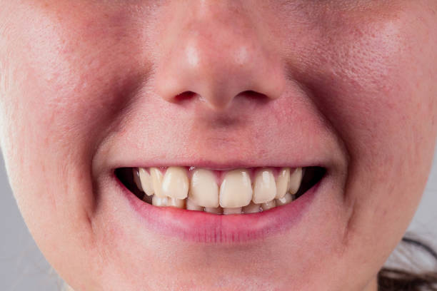 矯正歯科医のオフィスでスタジオ.treatmentブレースシステムのウィットの背景に若い女性の曲率歯と白い笑顔 - wobbly ストックフォトと画像