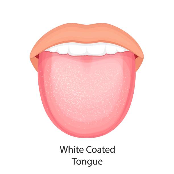 口腔の解剖学。白いコーティングを施した舌のベクターイラスト。 - virus unpleasant smell fungus animal点のイラスト素材／クリップアート素材／マンガ素材／アイコン素材