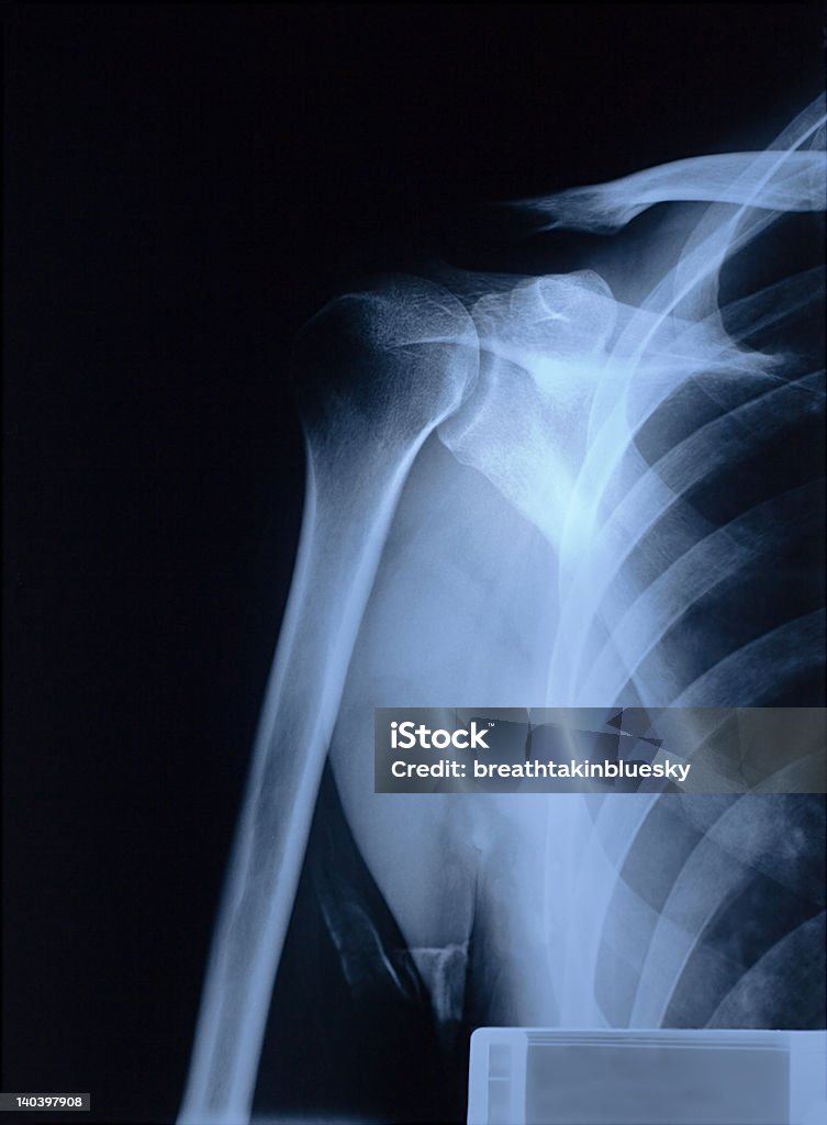 Radiografia a spalla - Foto stock royalty-free di Omero - Osso del braccio