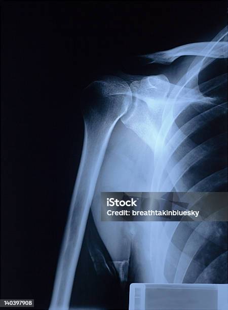 Radiografia A Spalla - Fotografie stock e altre immagini di Omero - Osso del braccio - Omero - Osso del braccio, Tumore, Anatomia umana