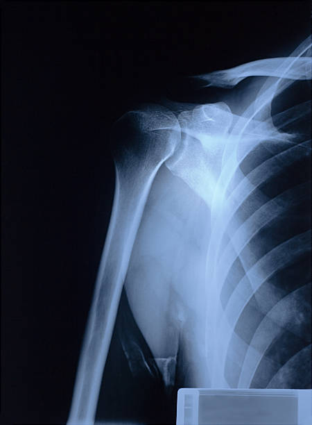 肩の x 線 - x ray shoulder humerus urgency ストックフォトと画像