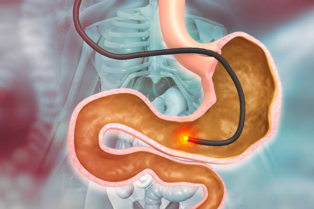 estómago humano con endoscopio y vista de cerca de la bacteria helicobacter pylori que causa úlceras, úlcera estomacal o úlcera gástrica, ilustración 3d - pylori fotografías e imágenes de stock