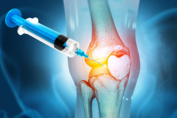 anatomy human knee joint treatment, osteoarthritis injection, drug method injection, knee injury, 3d illustration - 針筒 圖片 個照片及圖片檔