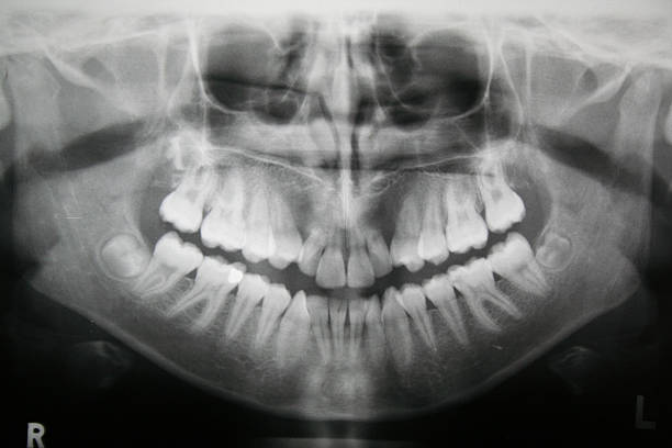 Dental X-ray of teeth showing fillings and spine