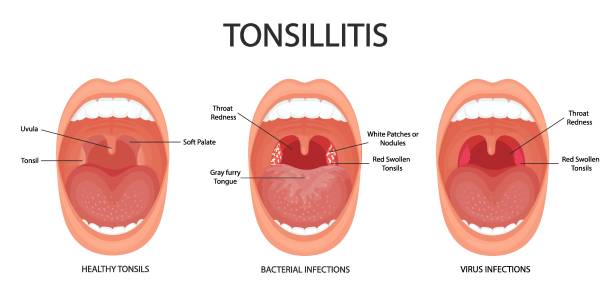 Angina, pharyngitis and tonsillitis. Tonsillitis bacterial and viral. Tonsil infection. Open mouth, anatomy. Angina, pharyngitis and tonsillitis. Tonsillitis bacterial and viral. Tonsil infection. Open mouth, anatomy. tonsil stock illustrations