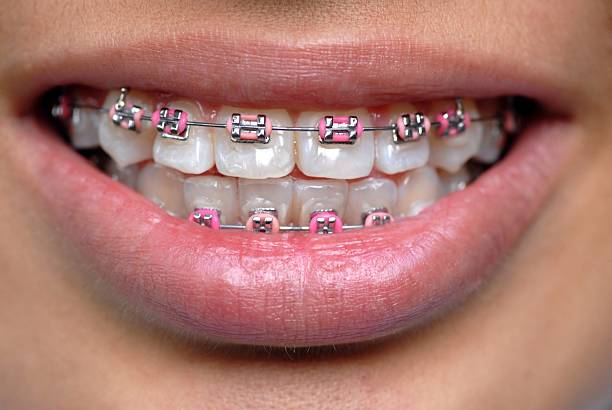 istock A woman smiling with dental braces 140411044