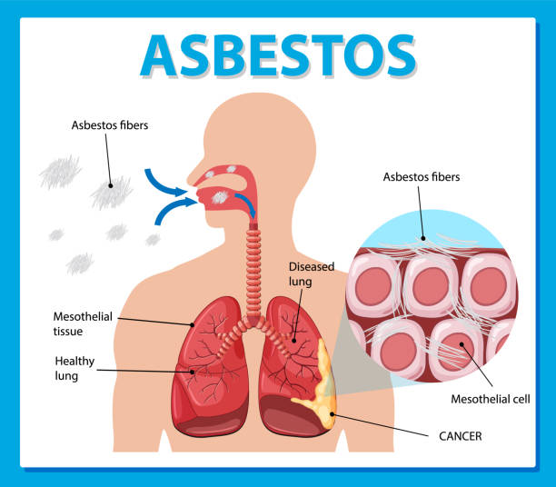 Diagram showing asbestosis in lungs Diagram showing asbestosis in lungs illustration clip art of a diagram of human lungs stock illustrations