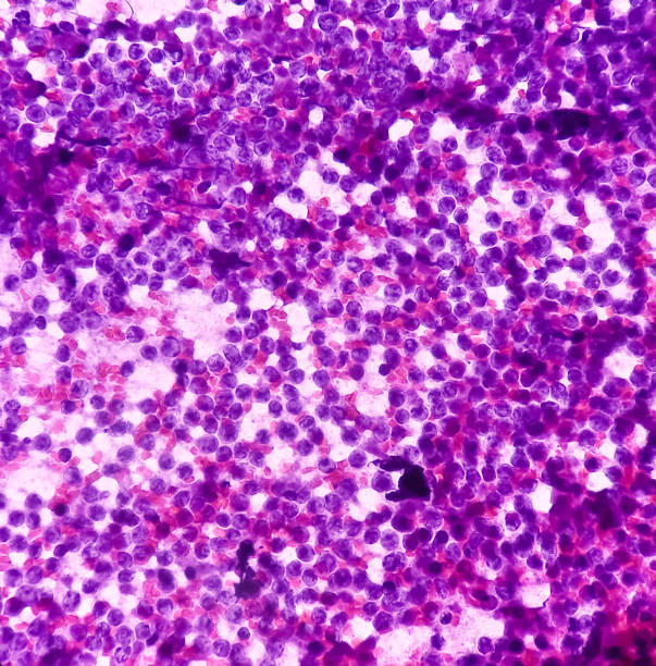 mikroskopische aufnahme einer lymphoproliferativen störung an der zervikalen lymphknotenzytologie. - hodgkins disease stock-fotos und bilder