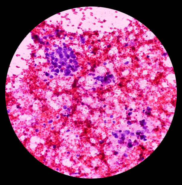 istock Metastatic Squamous cell carcinoma, Cholangiocarcinoma, adenocarcinoma, microscopic show malignant tumour cells, background of cecrotic debris and blood, 40x view. 1404166749