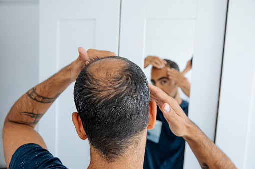 Hombre Calvo mirando espejo de cabeza pérdida de pelo y calvicie photo