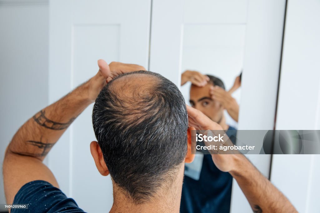 Bald man looking mirror at head baldness and hair loss Hair Loss Stock Photo