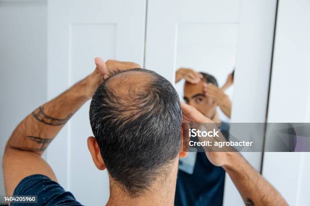 Bald Man Looking Mirror At Head Baldness And Hair Loss Stock Photo - Download Image Now
