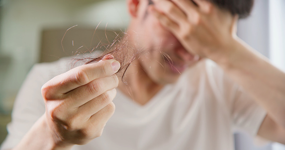 close up of asian man worry about his receding hairline and alopecia problem holding fallen hair in hand - he cover eye