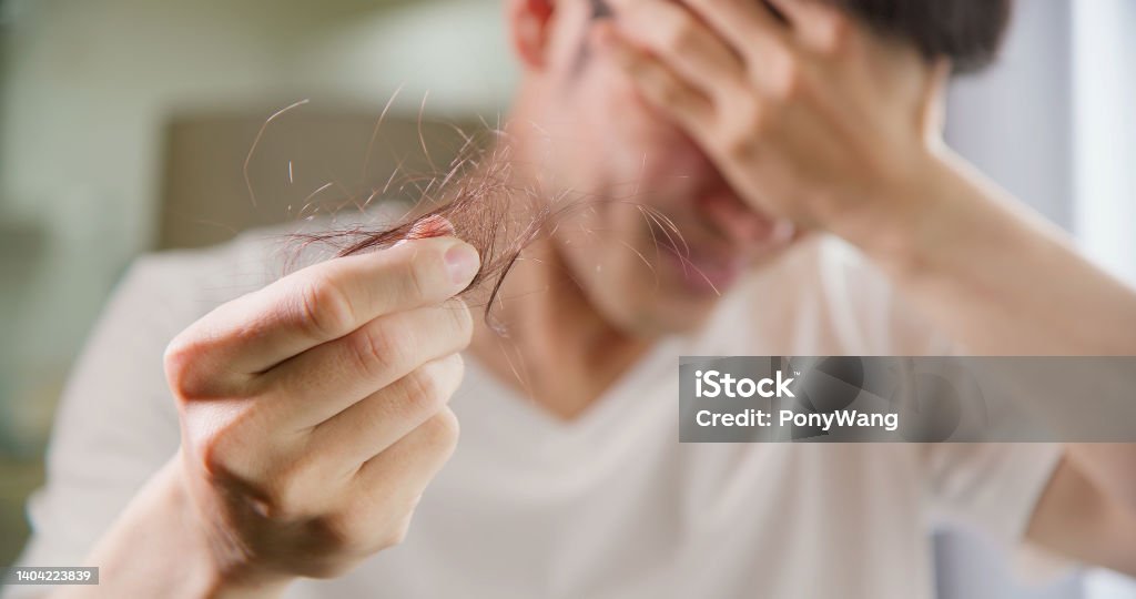man worried about hair loss close up of asian man worry about his receding hairline and alopecia problem holding fallen hair in hand - he cover eye Hair Loss Stock Photo