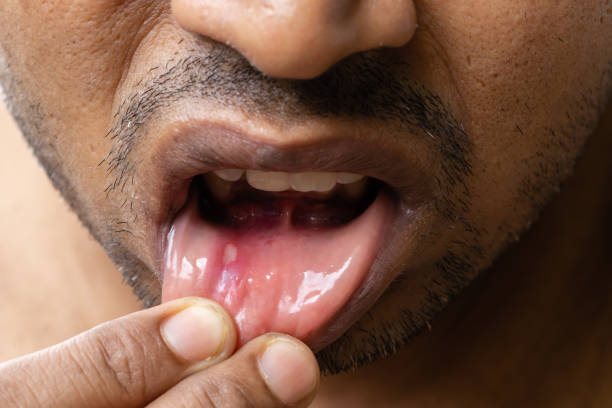 istock Painful mouth ulcer 1404226952