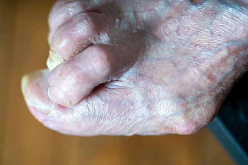 Feet of a woman with advanced stage bunion (Hallux abductus valgus)