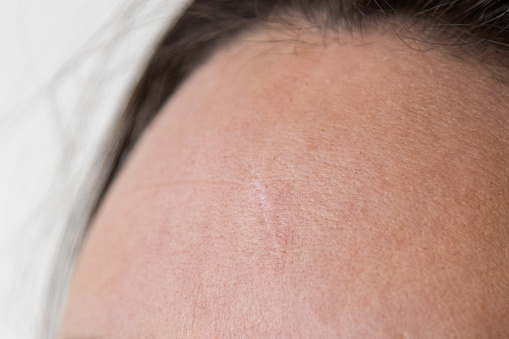 Scar on the forehead of a caucasian woman with brown hair. White background