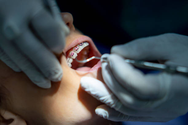 Woman at dentist placing braces on teeth