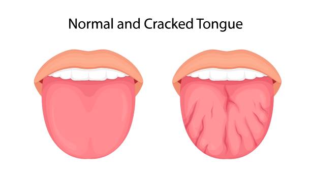 Disease Of The Tongue Cracks Medical Illustration Stock Illustration -  Download Image Now - iStock