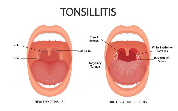 Angina, pharyngitis and tonsillitis. Tonsillitis is bacterial. Tonsil infection. Open mouth, anatomy. Angina, pharyngitis and tonsillitis. Tonsillitis is bacterial. Tonsil infection. Open mouth, anatomy. tonsil stock illustrations