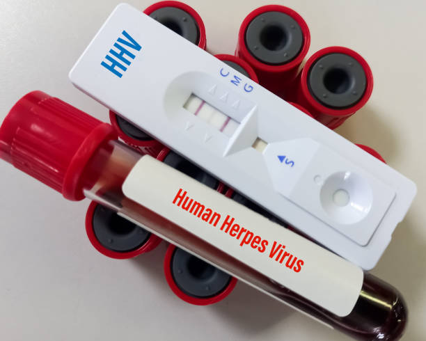 istock Blood sample with rapid test device for HHV (Human Herpes Virus) test, DNA virus. 1404336309