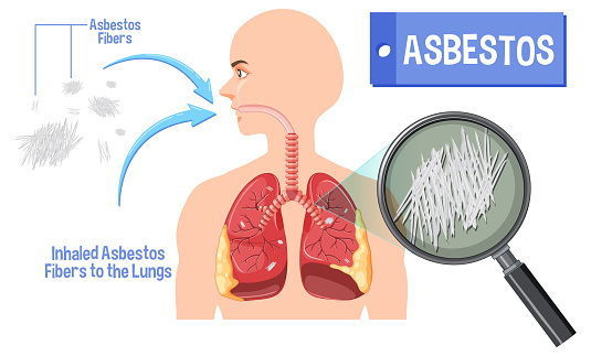 Diagram showing asbestosis in lungs illustration