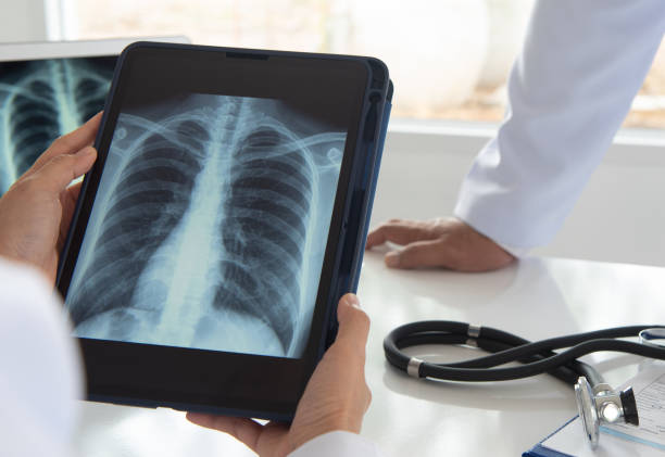 lung x-ray stock photo