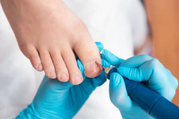 Photo of A chiropodist treats the cuticles on the toes with a mechanical device with an abrasive nozzle. Close-up, top view. The concept of chiropody and salon care feet