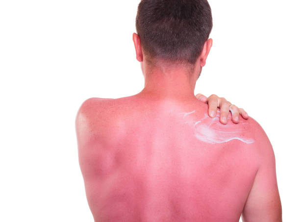 A man with a painfully tanned back and sunscreen on a white background A man with a painfully tanned back and sunscreen on a white background, sunburned red painfully stock pictures, royalty-free photos & images