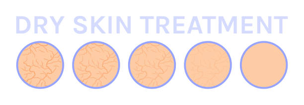 Dry Skin Icon. Cracks on Skin. Close Up. Treatment and Steps. Before After. Healthy and Soft skin. Effect of Cream and Moisturizer Mask. White background. Vector Illustration for Beauty design. Dry Skin Icon. Cracks on Skin. Close Up. Treatment and Steps. Before After. Healthy and Soft skin. Effect of Cream and Moisturizer Mask. White background. Vector Illustration for Beauty design. dry skin stock illustrations
