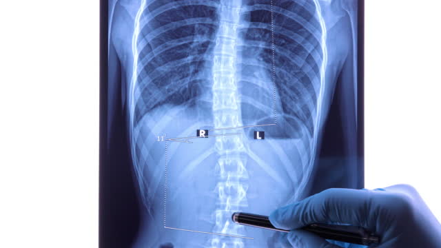 Doctor analyzing X ray of the spine showing scoliosis in the lumbar area