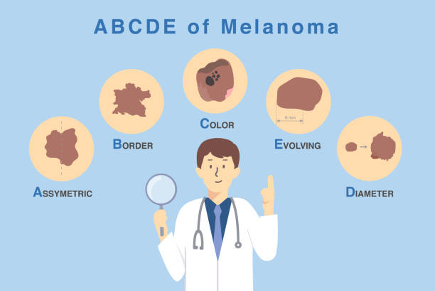 illustrazioni stock, clip art, cartoni animati e icone di tendenza di il medico che tiene ingrandisce il vetro con 5 caratteristiche di danno alla pelle da cellule tumorali. illustrazione sulla diagnosi e la classificazione del melanoma mediante l'uso della lettera abcde. - neo