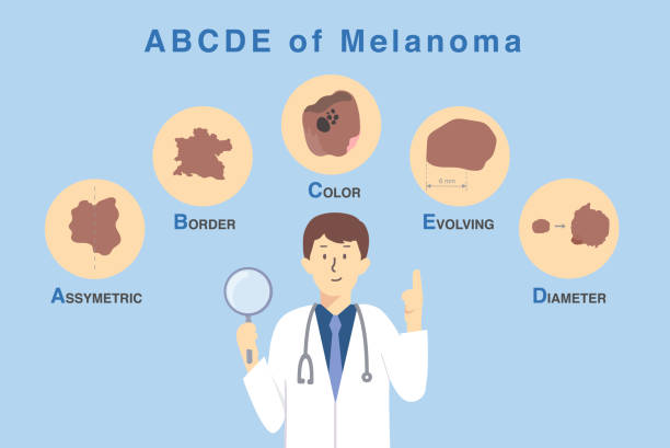 Doctor holding magnifies glass with 5 characteristics of skin damage from cancer cell. Illustration about diagnosis and classification of melanoma by use ABCDE letter. Doctor holding magnifies glass with 5 characteristics of skin damage from cancer cell. Illustration about diagnosis and classification of melanoma by use ABCDE letter. doctor borders stock illustrations