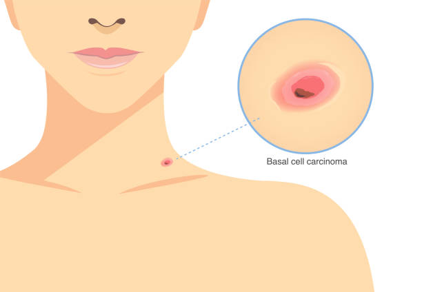 빨간 범프는 여성의 목에 기저 세포 암종입니다. 피부암, 의료 및 건강 검진에 대한 그림. - 기저세포암종 stock illustrations