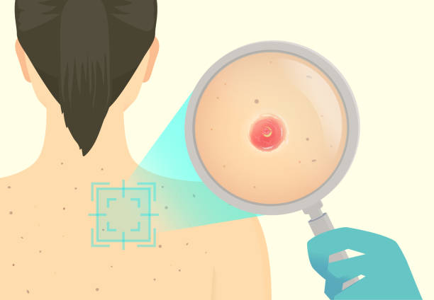docter의 손은 돋보기를 사용하여 여성의 등 피부에있는 기저 세포 암종을 스캔하고 확대합니다. dermoscopy로 암 진단에 대한 그림. 종양, 흑색종. - 기저세포암종 stock illustrations