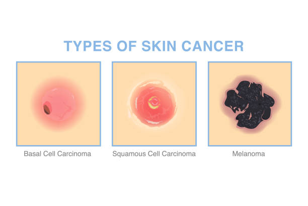 3 Types of skin cancer. Illustration about medical diagram of basal cell carcinoma, squamous cell carcinoma, and Melanoma for diagnosis and treatment of skin lesions. 3 Types of skin cancer. Illustration about medical diagram of basal cell carcinoma, squamous cell carcinoma, and Melanoma for diagnosis and treatment of skin lesions. melanoma stock illustrations