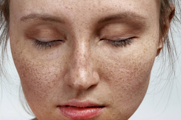 istock woman with freckles 1404505439