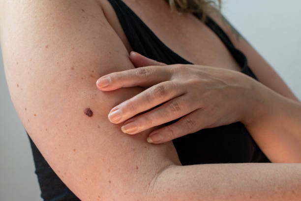 Abnormal mole on arm - skin cancer screening stock photo