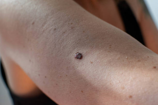 istock Abnormal mole on arm - skin cancer screening 1404600500
