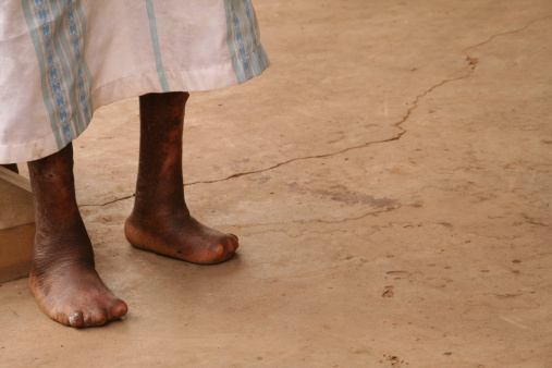 Disfigured feet of a man with leprosy, concrete floor background