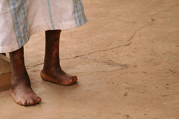 The Feet of a Leper Disfigured feet of a man with leprosy, concrete floor background leprosy stock pictures, royalty-free photos & images