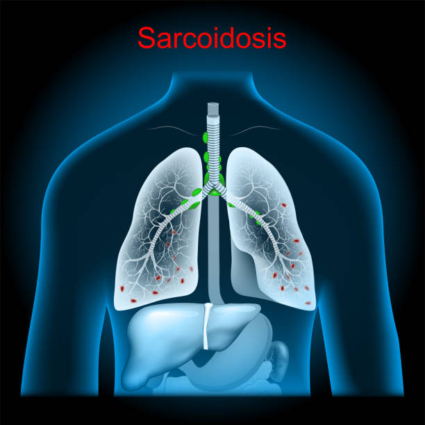 Sarcoidosis. Enlarged lymph nodes in the lungs Sarcoidosis. Enlarged lymph nodes. Lungs with granulomas, stomach and liver into x-ray blue realistic torso. Human silhouette on dark background. respiratory system. Vector poster erythema nodosum stock illustrations