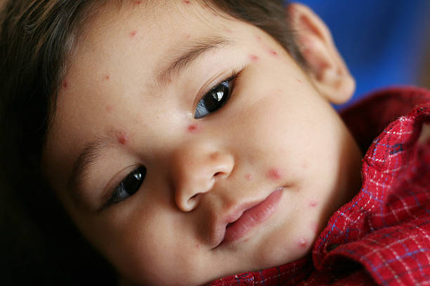istock Baby boy with mid-stage chicken pox 140469752