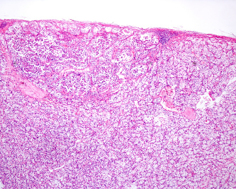 Human kidney. Low magnification micrograph showing a renal clear cell carcinoma (RCC) nodule. Malignant epithelial cells with clear cytoplasm and a solid growth pattern interspersed with intricate, arborizing vasculature.