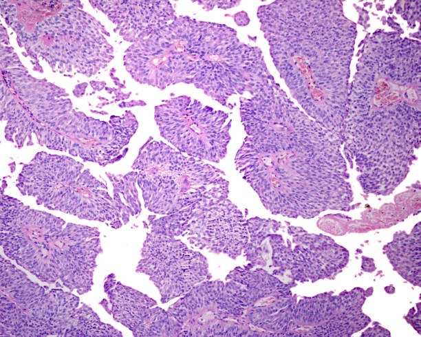 Human urinary bladder. Papillary carcinoma Low grade papillary carcinoma (urothelial carcinoma) formed by papillae with fibrovascular core and coated with transitional epithelium. Cells are relatively uniform without nuclear polymorphism and lack of cellular polarity. urothelium stock pictures, royalty-free photos & images